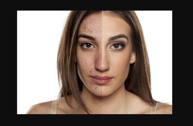 Hormonal Acne