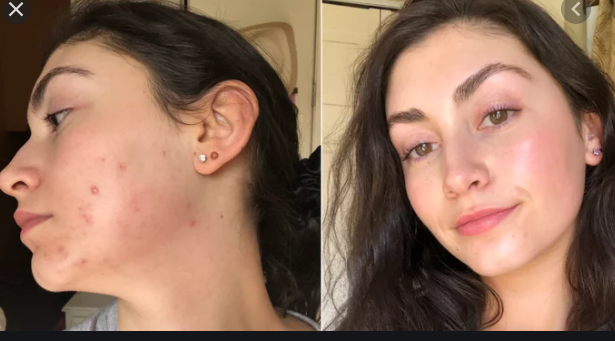 Treat-Hormonal-Acne